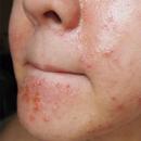 Аллергия на крем для лица – что делать и как лечить?
