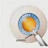 Cataract surgery: phacoemulsification with IOL implantation Phacoemulsification of cataract with intraocular lens implantation