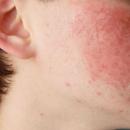 Что делать для устранения аллергии на коже лица?